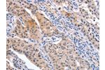 The image on the left is immunohistochemistry of paraffin-embedded Human lung cancer tissue using CSB-PA569443(CD59 Antibody) at dilution 1/30, on the right is treated with synthetic peptide. (Original magnification: 