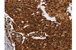 The image on the left is immunohistochemistry of paraffin-embedded Human cervical cancer tissue using CSB-PA569454(FANCF Antibody) at dilution 1/60, on the right is treated with fusion protein. (Original magnification: 