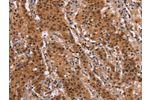 The image on the left is immunohistochemistry of paraffin-embedded Human gastric cancer tissue using CSB-PA569524(FOSL1 Antibody) at dilution 1/30, on the right is treated with synthetic peptide. (Original magnification: 