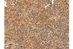 The image on the left is immunohistochemistry of paraffin-embedded Human liver cancer tissue using CSB-PA569791(BRS3 Antibody) at dilution 1/30, on the right is treated with synthetic peptide. (Original magnification: 