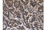 The image is immunohistochemistry of paraffin-embedded Human liver cancer tissue using CSB-PA570140(FRK Antibody) at dilution 1/50. (Original magnification: 