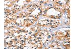 The image on the left is immunohistochemistry of paraffin-embedded Human thyroid cancer tissue using CSB-PA570255(BNIP3L Antibody) at dilution 1/40, on the right is treated with synthetic peptide. (Original magnification: 