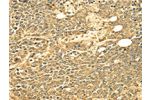 The image on the left is immunohistochemistry of paraffin-embedded Human ovarian cancer tissue using CSB-PA570366(ECE2 Antibody) at dilution 1/25, on the right is treated with fusion protein. (Original magnification: 