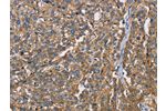 The image on the left is immunohistochemistry of paraffin-embedded Human esophagus cancer tissue using CSB-PA570608(BSG Antibody) at dilution 1/60, on the right is treated with fusion protein. (Original magnification: 