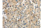 The image on the left is immunohistochemistry of paraffin-embedded Human liver cancer tissue using CSB-PA571004(CLDN19 Antibody) at dilution 1/35, on the right is treated with synthetic peptide. (Original magnification: 