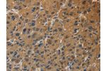 The image on the left is immunohistochemistry of paraffin-embedded Human liver cancer tissue using CSB-PA571416(DUSP23 Antibody) at dilution 1/30, on the right is treated with fusion protein. (Original magnification: 