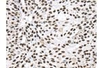 The image on the left is immunohistochemistry of paraffin-embedded Human breast cancer tissue using CSB-PA571464(DDX39B Antibody) at dilution 1/40, on the right is treated with synthetic peptide. (Original magnification: 