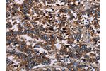 The image on the left is immunohistochemistry of paraffin-embedded Human liver cancer tissue using CSB-PA571561(F11R Antibody) at dilution 1/40, on the right is treated with fusion protein. (Original magnification: 