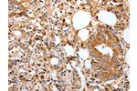 The image on the left is immunohistochemistry of paraffin-embedded Human stomach cancer tissue using CSB-PA572384(FOXO3 Antibody) at dilution 1/17, on the right is treated with synthetic peptide. (Original magnification: 
