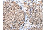 The image on the left is immunohistochemistry of paraffin-embedded Human breast cancer tissue using CSB-PA572404(CTBP1 Antibody) at dilution 1/65, on the right is treated with synthetic peptide. (Original magnification: 