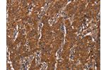 The image on the left is immunohistochemistry of paraffin-embedded Human gastic cancer tissue using CSB-PA572419(DCTN6 Antibody) at dilution 1/60, on the right is treated with fusion protein. (Original magnification: 