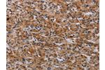 The image on the left is immunohistochemistry of paraffin-embedded Human prostate cancer tissue using CSB-PA572574(F2RL2 Antibody) at dilution 1/30, on the right is treated with synthetic peptide. (Original magnification: 