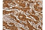 The image on the left is immunohistochemistry of paraffin-embedded Human gastic cancer tissue using CSB-PA572968(DDX4 Antibody) at dilution 1/25, on the right is treated with synthetic peptide. (Original magnification: 
