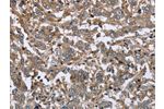The image on the left is immunohistochemistry of paraffin-embedded Human liver cancer tissue using CSB-PA573035(FCAR Antibody) at dilution 1/20, on the right is treated with fusion protein. (Original magnification: 