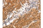 The image on the left is immunohistochemistry of paraffin-embedded Human gastic cancer tissue using CSB-PA573522(BCL3 Antibody) at dilution 1/15, on the right is treated with synthetic peptide. (Original magnification: 