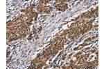 The image on the left is immunohistochemistry of paraffin-embedded Human gastic cancer tissue using CSB-PA573955(ARSB Antibody) at dilution 1/50, on the right is treated with synthetic peptide. (Original magnification: 
