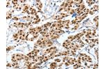 The image on the left is immunohistochemistry of paraffin-embedded Human breast cancer tissue using CSB-PA574741(ANXA10 Antibody) at dilution 1/35, on the right is treated with fusion protein. (Original magnification: 