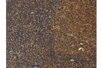 The image on the left is immunohistochemistry of paraffin-embedded Human tonsil tissue using CSB-PA574764(DAB2 Antibody) at dilution 1/30, on the right is treated with fusion protein. (Original magnification: 