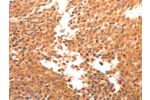 The image on the left is immunohistochemistry of paraffin-embedded Human breast cancer tissue using CSB-PA574868(BDKRB2 Antibody) at dilution 1/30, on the right is treated with synthetic peptide. (Original magnification: 