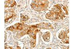 The image on the left is immunohistochemistry of paraffin-embedded Human breast cancer tissue using CSB-PA575032(ACE Antibody) at dilution 1/70, on the right is treated with synthetic peptide. (Original magnification: 