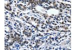 The image on the left is immunohistochemistry of paraffin-embedded Human gastic cancer tissue using CSB-PA575380(ENPP3 Antibody) at dilution 1/80, on the right is treated with synthetic peptide. (Original magnification: 