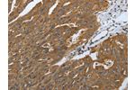 The image on the left is immunohistochemistry of paraffin-embedded Human ovarian cancer tissue using CSB-PA575557(DLG4 Antibody) at dilution 1/40, on the right is treated with synthetic peptide. (Original magnification: 