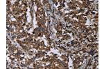 The image on the left is immunohistochemistry of paraffin-embedded Human liver cancer tissue using CSB-PA576137(DNAJC15 Antibody) at dilution 1/40, on the right is treated with fusion protein. (Original magnification: 