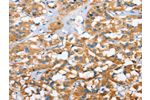 The image on the left is immunohistochemistry of paraffin-embedded Human thyroid cancer tissue using CSB-PA576532(CXCL14 Antibody) at dilution 1/40, on the right is treated with fusion protein. (Original magnification: 
