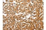 The image on the left is immunohistochemistry of paraffin-embedded Human thyroid cancer tissue using CSB-PA576592(ANXA9 Antibody) at dilution 1/30, on the right is treated with fusion protein. (Original magnification: 