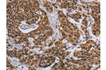 The image on the left is immunohistochemistry of paraffin-embedded Human cervical cancer tissue using CSB-PA576836(CCL21 Antibody) at dilution 1/40, on the right is treated with fusion protein. (Original magnification: 