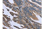 The image on the left is immunohistochemistry of paraffin-embedded Human gastic cancer tissue using CSB-PA576871(GNAI3 Antibody) at dilution 1/40, on the right is treated with fusion protein. (Original magnification: 
