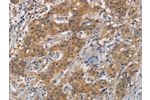 The image is immunohistochemistry of paraffin-embedded Human gastic cancer tissue using CSB-PA577711(AXIN2 Antibody) at dilution 1/20. (Original magnification: 