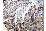 The image on the left is immunohistochemistry of paraffin-embedded Human lung cancer tissue using CSB-PA577887(CTSZ Antibody) at dilution 1/25, on the right is treated with fusion protein. (Original magnification: 