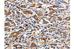 The image on the left is immunohistochemistry of paraffin-embedded Human gastic cancer tissue using CSB-PA578073(CLDN5 Antibody) at dilution 1/10, on the right is treated with synthetic peptide. (Original magnification: 