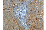 The image on the left is immunohistochemistry of paraffin-embedded Human cervical cancer tissue using CSB-PA578122(ASAH1 Antibody) at dilution 1/50, on the right is treated with fusion protein. (Original magnification: 