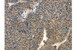 The image on the left is immunohistochemistry of paraffin-embedded Human liver cancer tissue using CSB-PA578311(COL4A2 Antibody) at dilution 1/70, on the right is treated with synthetic peptide. (Original magnification: 