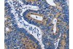 The image on the left is immunohistochemistry of paraffin-embedded Human colon cancer tissue using CSB-PA578519(BPIFB3 Antibody) at dilution 1/50, on the right is treated with synthetic peptide. (Original magnification: 