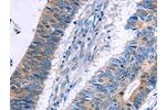 The image on the left is immunohistochemistry of paraffin-embedded Human colon cancer tissue using CSB-PA578770(ERBB3 Antibody) at dilution 1/20, on the right is treated with fusion protein. (Original magnification: 
