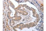 The image on the left is immunohistochemistry of paraffin-embedded Human colon cancer tissue using CSB-PA578796(CDK20 Antibody) at dilution 1/15, on the right is treated with fusion protein. (Original magnification: 