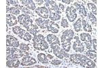 The image on the left is immunohistochemistry of paraffin-embedded Human esophagus cancer tissue using CSB-PA579290(COX4I1 Antibody) at dilution 1/25, on the right is treated with synthetic peptide. (Original magnification: 