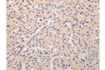 The image on the left is immunohistochemistry of paraffin-embedded Human liver cancer tissue using CSB-PA579827(ABCC1 Antibody) at dilution 1/20, on the right is treated with synthetic peptide. (Original magnification: 