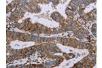The image on the left is immunohistochemistry of paraffin-embedded Human colon cancer tissue using CSB-PA579941(AQP4 Antibody) at dilution 1/20, on the right is treated with synthetic peptide. (Original magnification: 