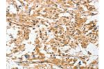 The image on the left is immunohistochemistry of paraffin-embedded Human thyroid cancer tissue using CSB-PA580017(ANGPTL7 Antibody) at dilution 1/30, on the right is treated with fusion protein. (Original magnification: 