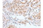 The image on the left is immunohistochemistry of paraffin-embedded Human lung cancer tissue using CSB-PA580508(ATF2 Antibody) at dilution 1/15, on the right is treated with fusion protein. (Original magnification: 