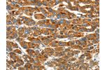 The image on the left is immunohistochemistry of paraffin-embedded Human liver cancer tissue using CSB-PA580639(ERP44 Antibody) at dilution 1/20, on the right is treated with synthetic peptide. (Original magnification: 