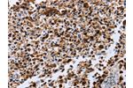 The image on the left is immunohistochemistry of paraffin-embedded Human lung cancer tissue using CSB-PA580658(CXCR3  Antibody) at dilution 1/20, on the right is treated with synthetic peptide. (Original magnification: 