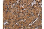 The image on the left is immunohistochemistry of paraffin-embedded Human liver cancer tissue using CSB-PA580837(DISC1 Antibody) at dilution 1/20, on the right is treated with synthetic peptide. (Original magnification: 