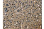 The image is immunohistochemistry of paraffin-embedded Human liver cancer tissue using CSB-PA581290(CORO1C Antibody) at dilution 1/60. (Original magnification: 