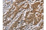 The image on the left is immunohistochemistry of paraffin-embedded Human gastic cancer tissue using CSB-PA581463(ATP2C1 Antibody) at dilution 1/60, on the right is treated with fusion protein. (Original magnification: 