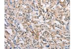 The image on the left is immunohistochemistry of paraffin-embedded Human thyroid cancer tissue using CSB-PA581946(CLDN11 Antibody) at dilution 1/25, on the right is treated with synthetic peptide. (Original magnification: 